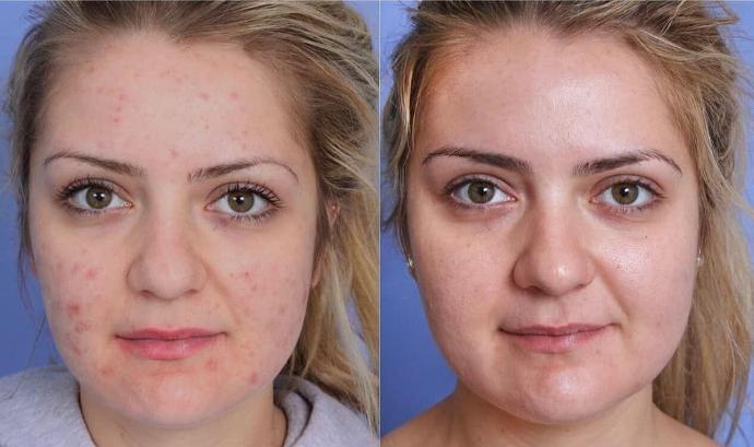 acne avant apres femme 